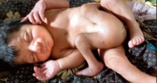 Подарок богов: молодые родители шокированы рождением младенца с четырьмя ногами – Times Of India