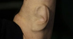 В Китае мужчине пересадили ухо, выращенное на его же руке